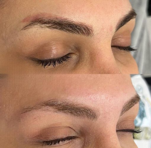 Non-laser Tattoo Removal1