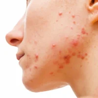 Acne