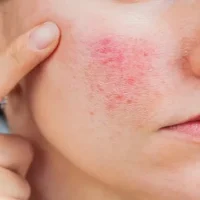 Eczema