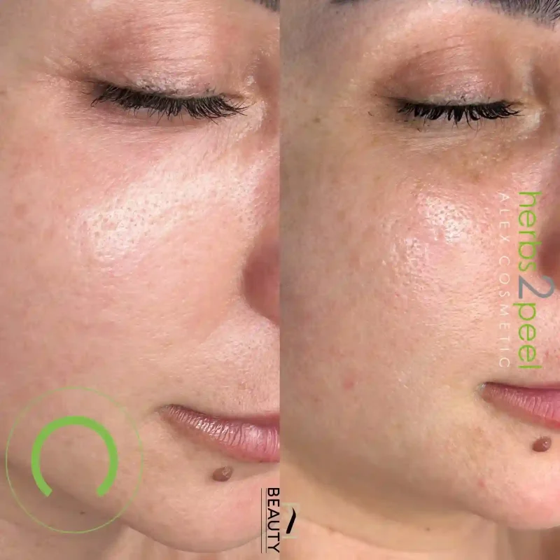 Hydration Facial