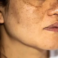 Pigmentation
