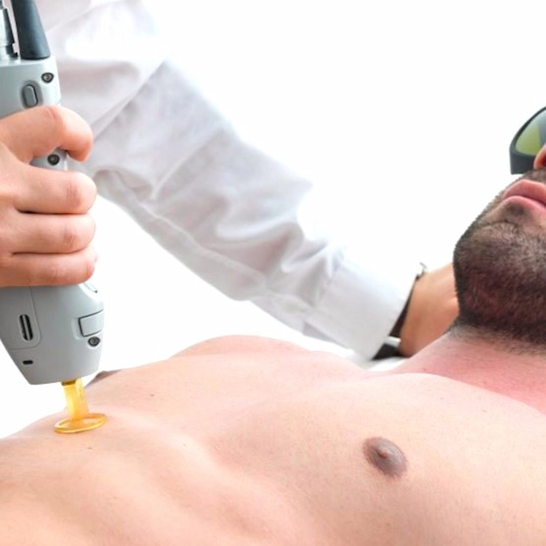 Is Laser Hair Removal Safe for All Skin Types