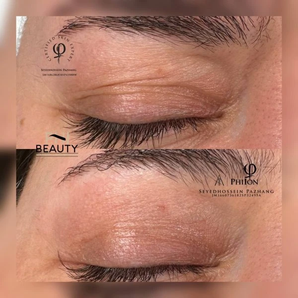 Plasma fibroblast eyelid tightening before and after results