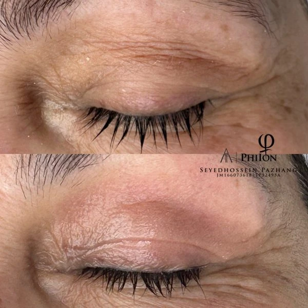 Plasma fibroblast eyelid tightening before and after results