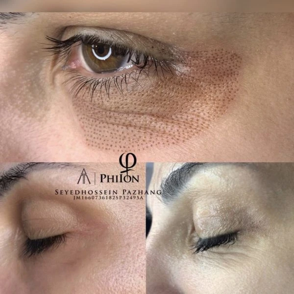 Plasma fibroblast eyelid tightening before and after results