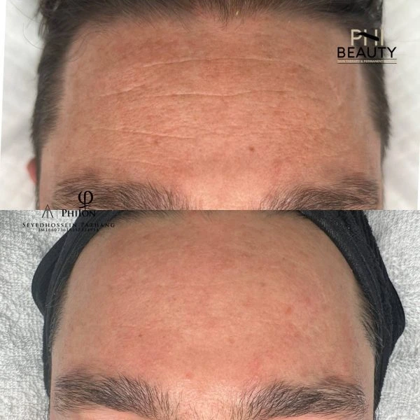 Plasma fibroblast eyelid tightening before and after results