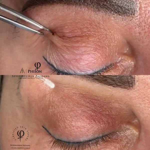 Plasma fibroblast eyelid tightening before and after results