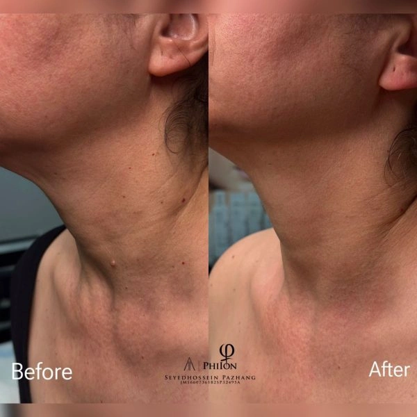 Plasma Fibroblast Neck Tightening