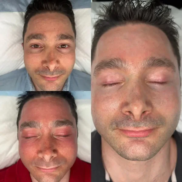 Plasma fibroblast eyelid tightening before and after results