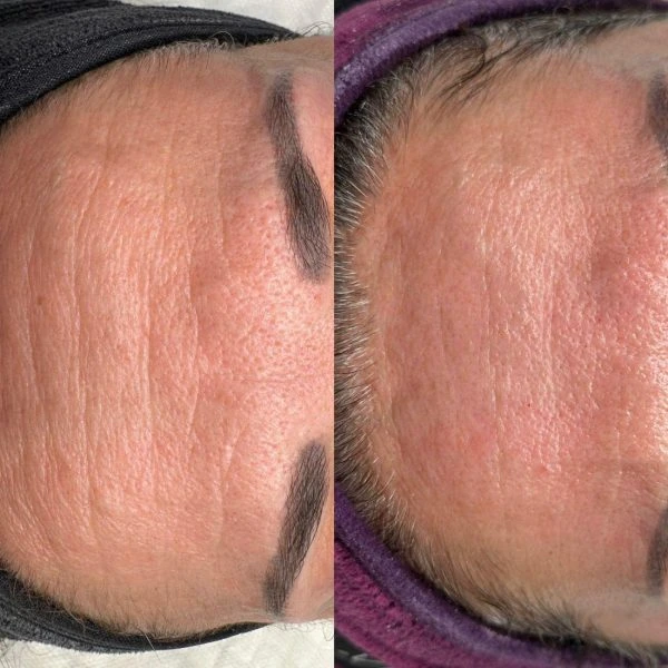 Plasma fibroblast eyelid tightening before and after results