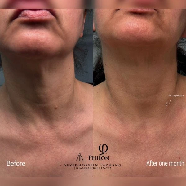 Plasma fibroblast eyelid tightening before and after results