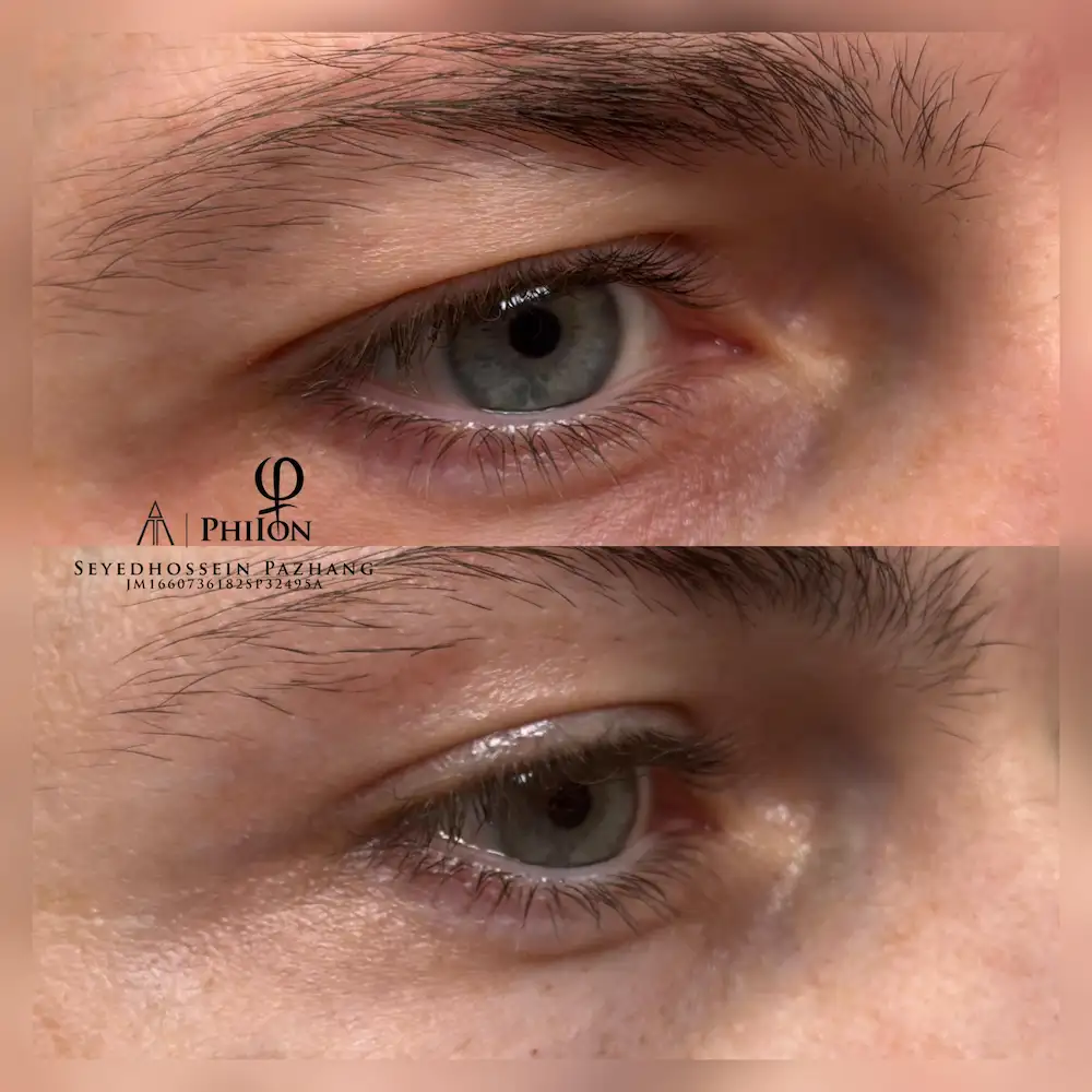 Plasma Fibroblast Eyelids