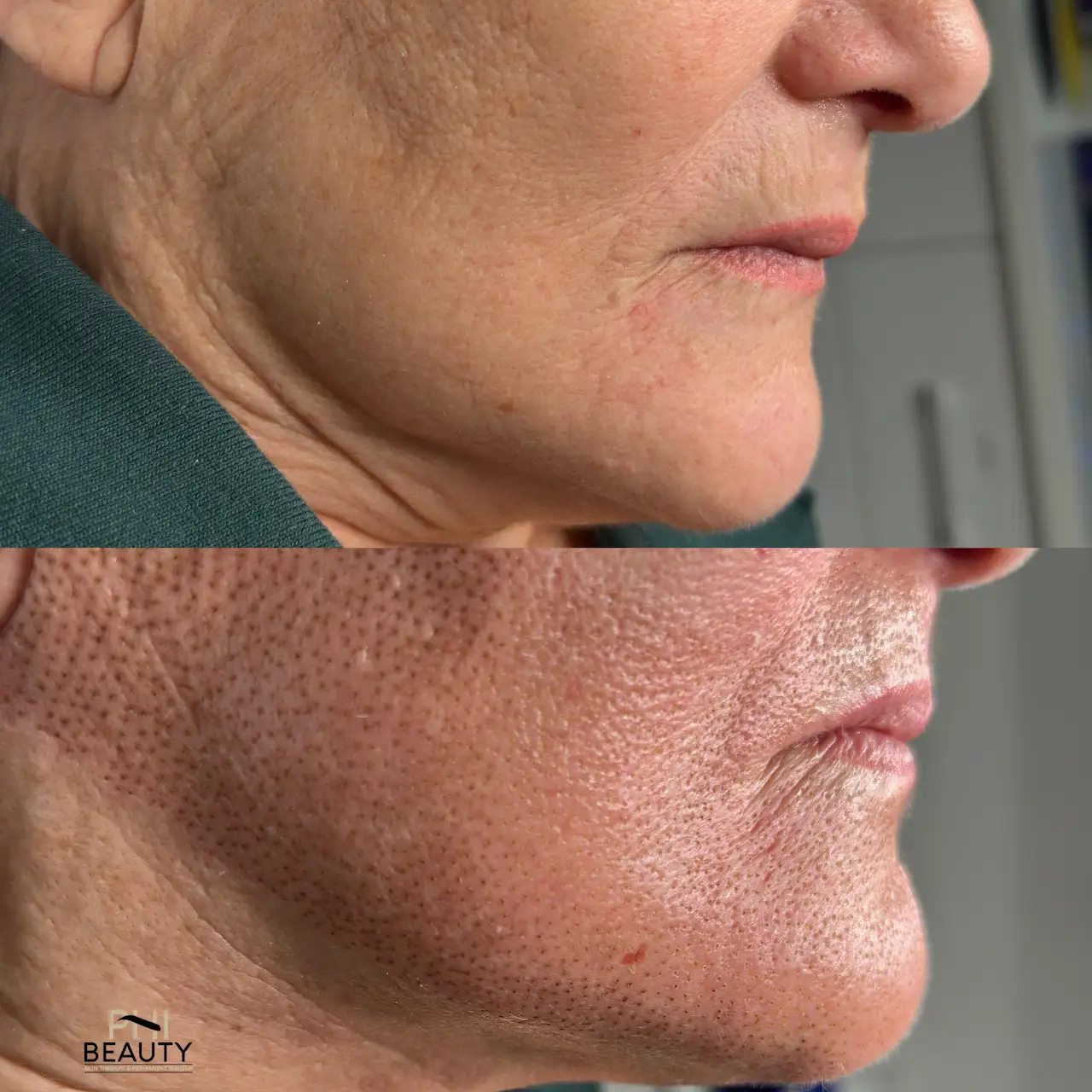 Plasma Fibroblast Smile Lines