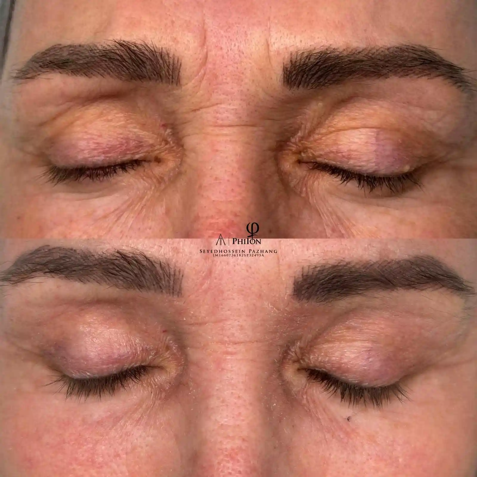Plasma Fibroblast Under Eyes