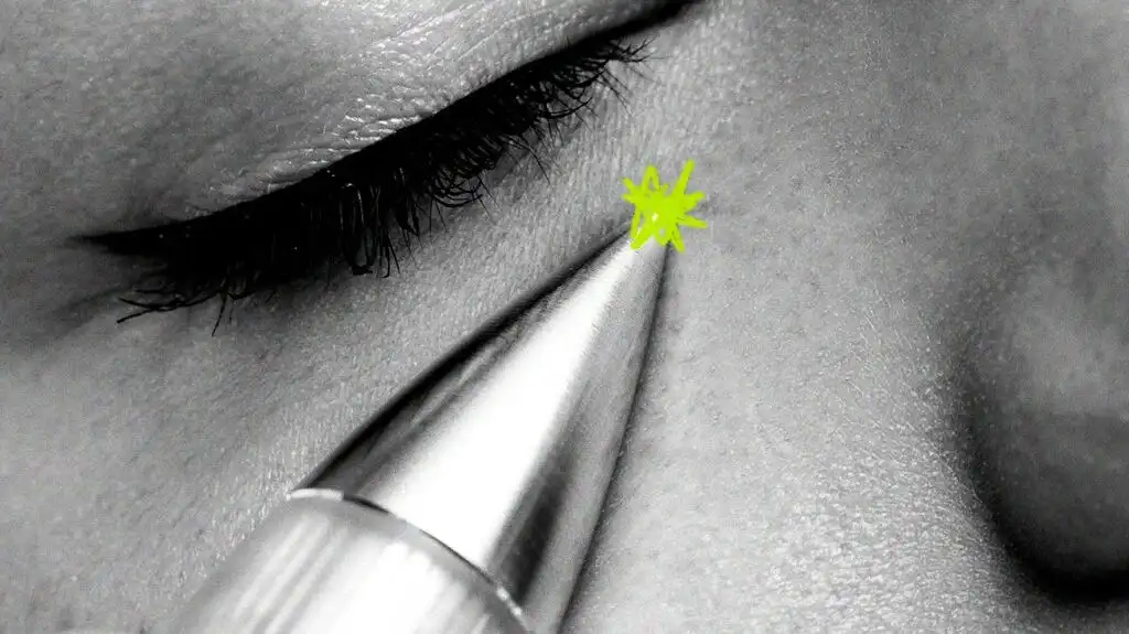 Benefits of plasma fibroblast therapy