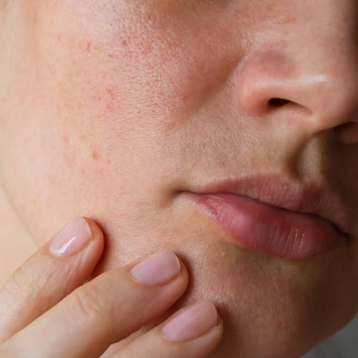 Laser Hair Removal for Sensitive Skin