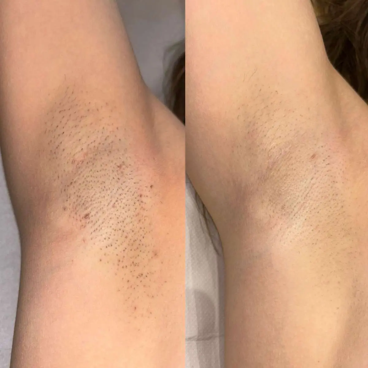 Underarm Laser Hair Removal