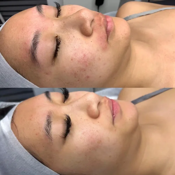 Acne Control Facial