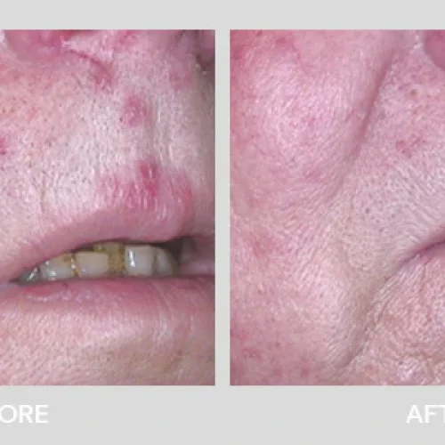 lutronic-healite-II-ba3